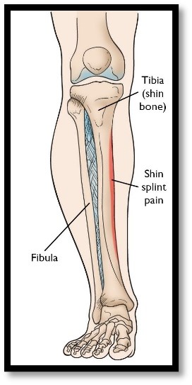 shin bone bruise